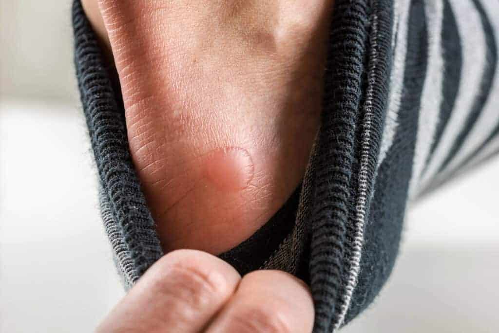 Blisters Why They Happen And How To Prevent Them