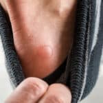 Blisters Why They Happen And How To Prevent Them